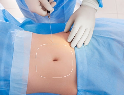 Laser lipolysis